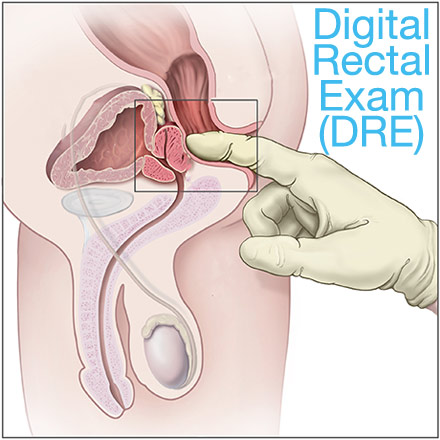 digital rectal exam for constipation